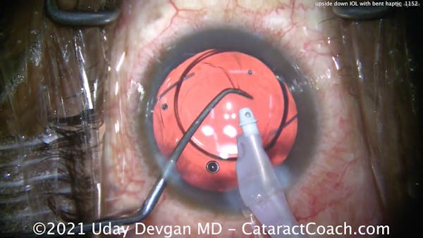 Upside-Down IOL With Bent Haptic thumbnail