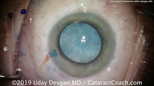 What is Different About This White Cataract?