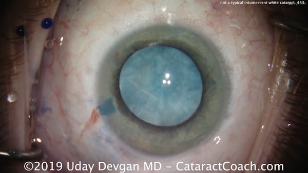 What is Different About This White Cataract? thumbnail
