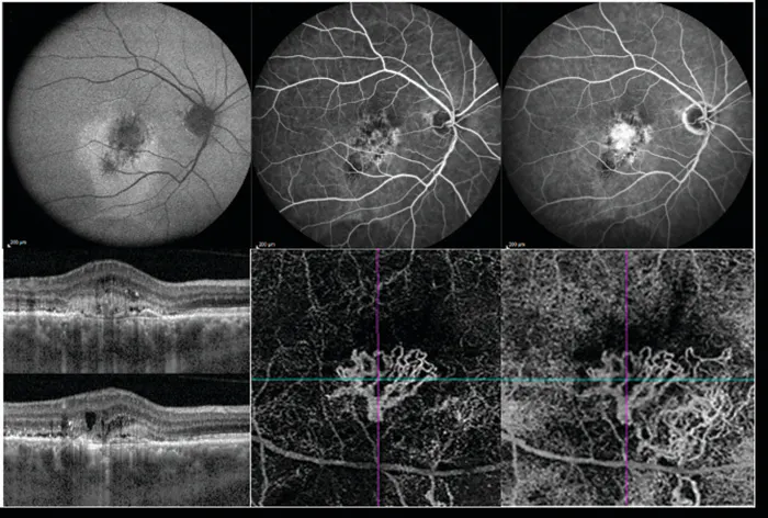 Clinical Utility of OCT Angiography for Retinal and Choroidal Vascular ...
