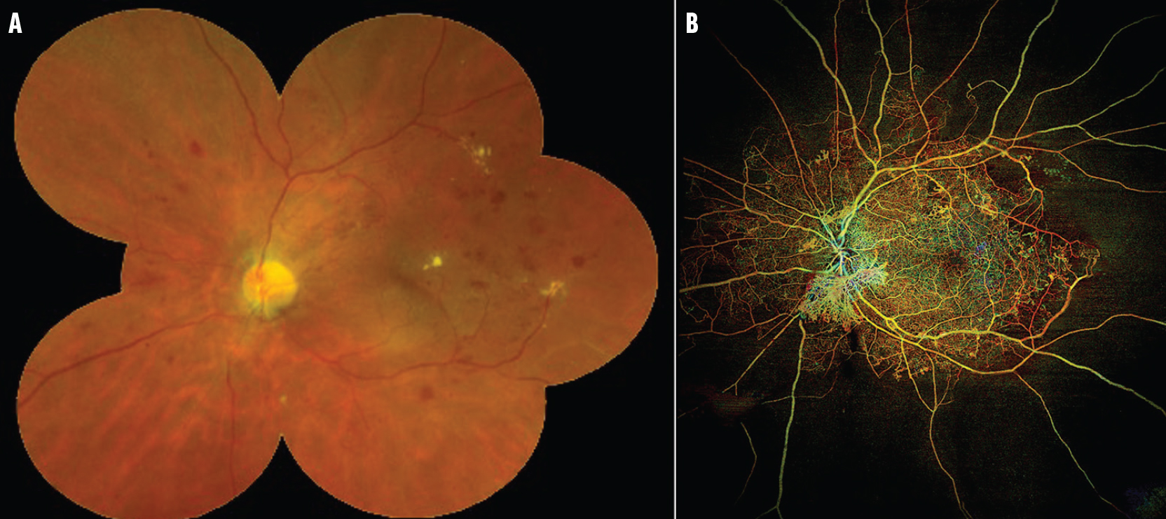 Widefield OCTA: A New Way To Stage Diabetic Retinopathy - Retina Today