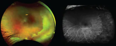 Chronic CME After ARN image