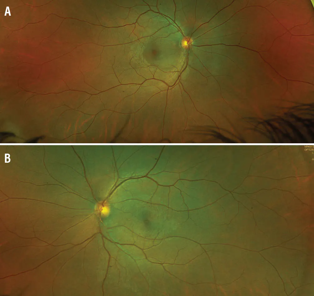 CSCR Secondary to Sinus Surgery image