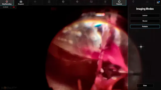 Vitreous Hemorrhage thumbnail