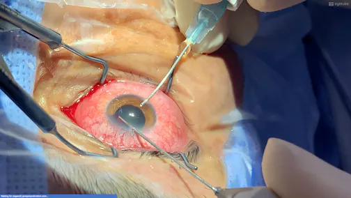 How to Evacuate This Hyphema Quickly, Easily, and Without Causing a Cataract