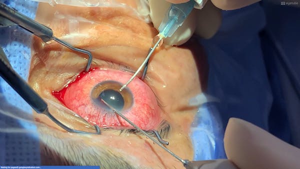How to Evacuate This Hyphema Quickly, Easily, and Without Causing a Cataract thumbnail