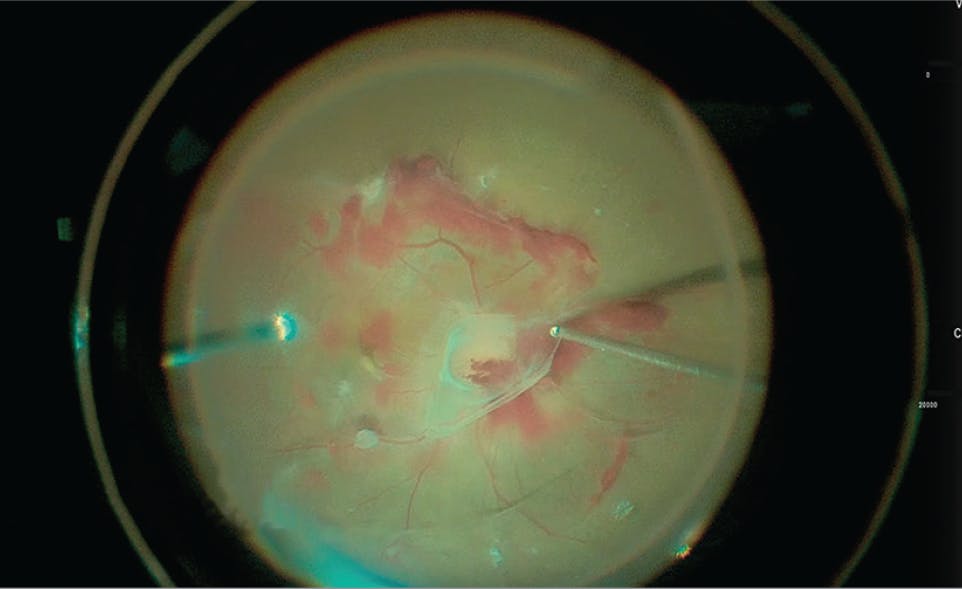 Vitreous Separation - Retina Vitreous Consultants, Inc