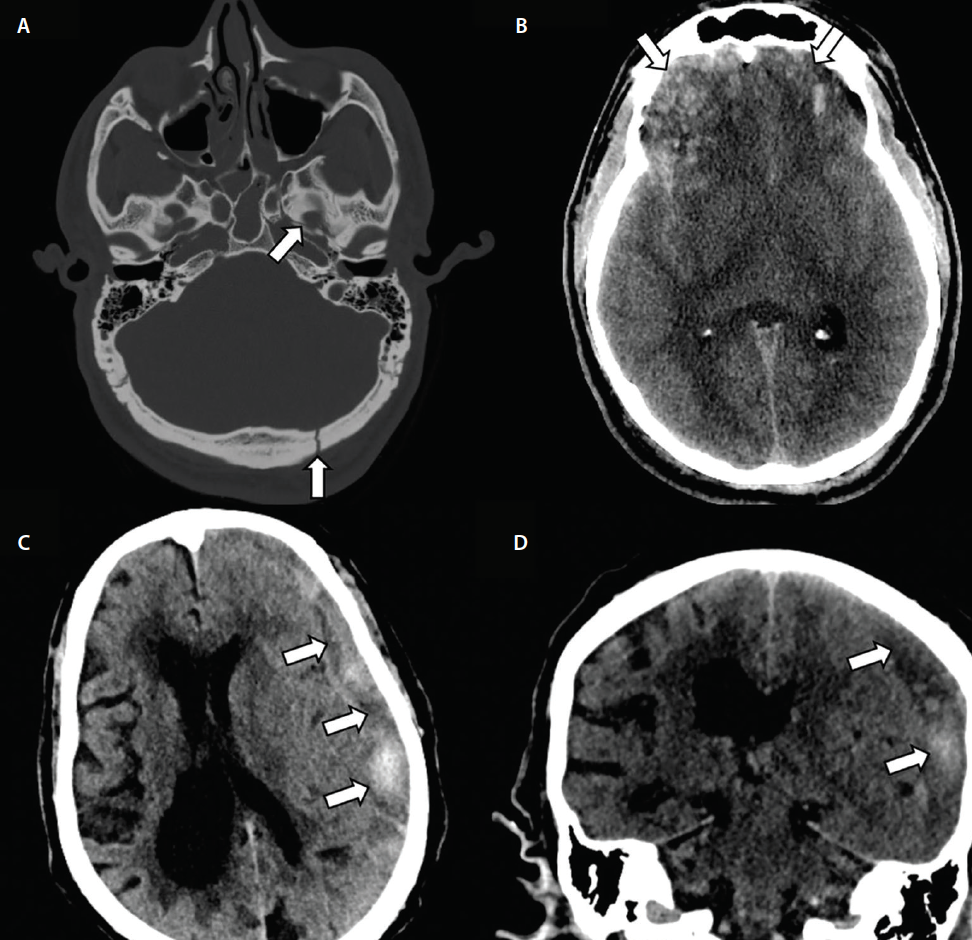 Magnetic resonance imaging. Large intracranial hemorrhage with moderate