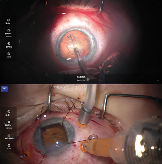 Considerations for Combined Phacoemulsification Vitrectomy