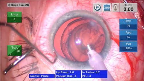 Surgical Pearls on How to Handle Ectopia Lentis: Lens Removal, IOL, CTR, Sutured CTS
