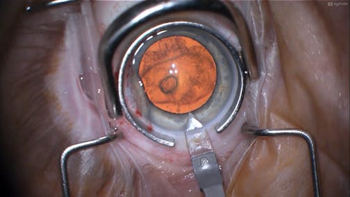 Phacoemulsification After Pars Plana Vitrectomy: Cataract Surgery Concepts and Pearls