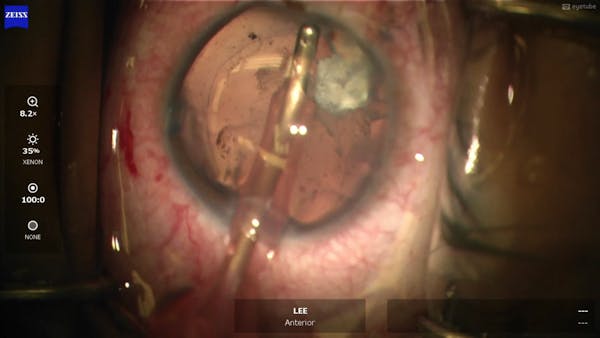 Posterior Capsule Membrane Peel thumbnail