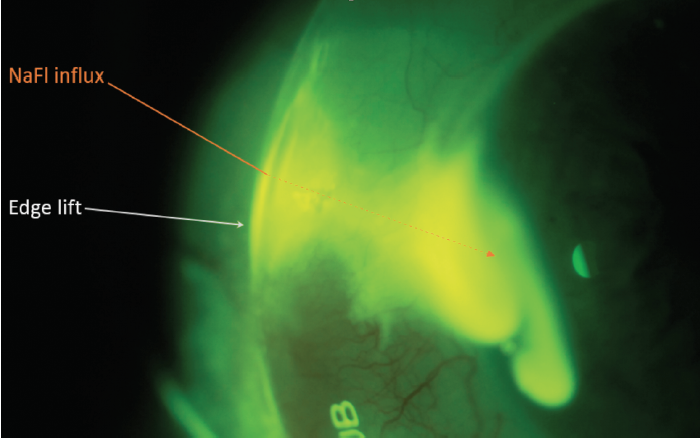 Allergy Management In Scleral Lens Wearers Modern Optometry 3023