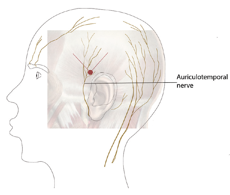 Procedural Treatments for Headache Disorders - Practical Neurology