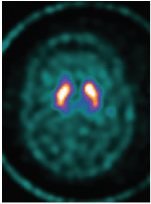 Case Report Hemiparkinsonism In A Patient With Multiple Sclerosis Practical Neurology 5549