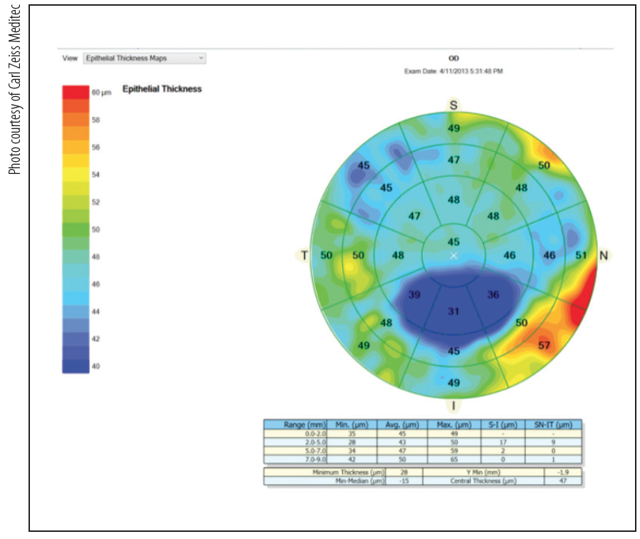 Update on Keratoconus Treatment Modern Optometry