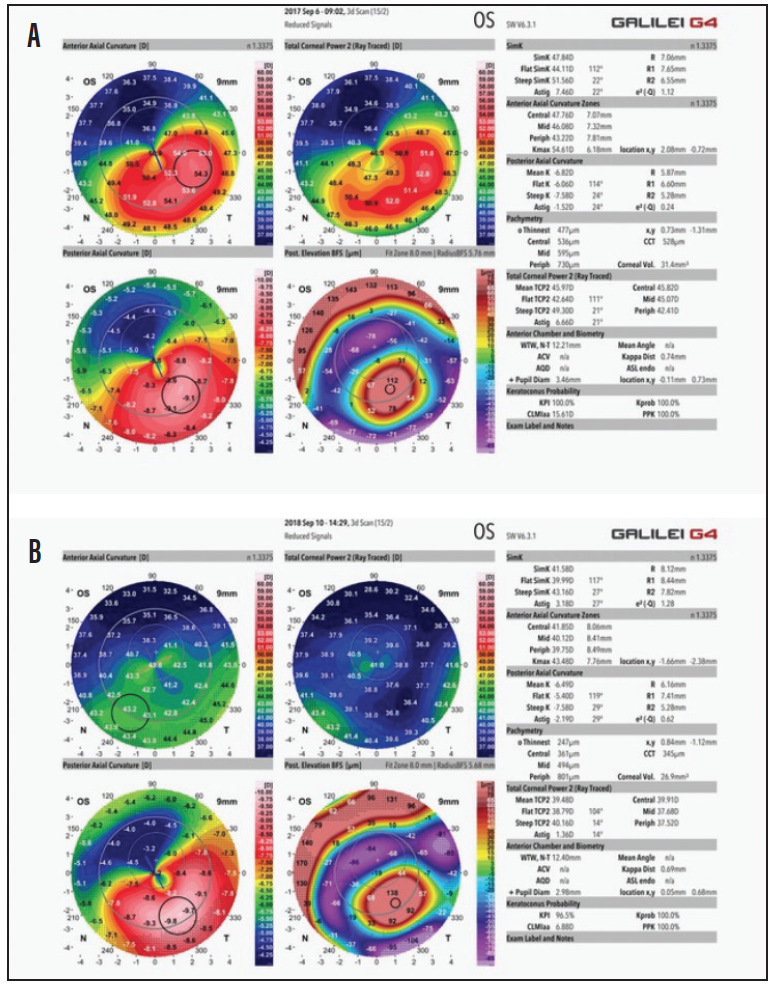 Update on Keratoconus Treatment Modern Optometry