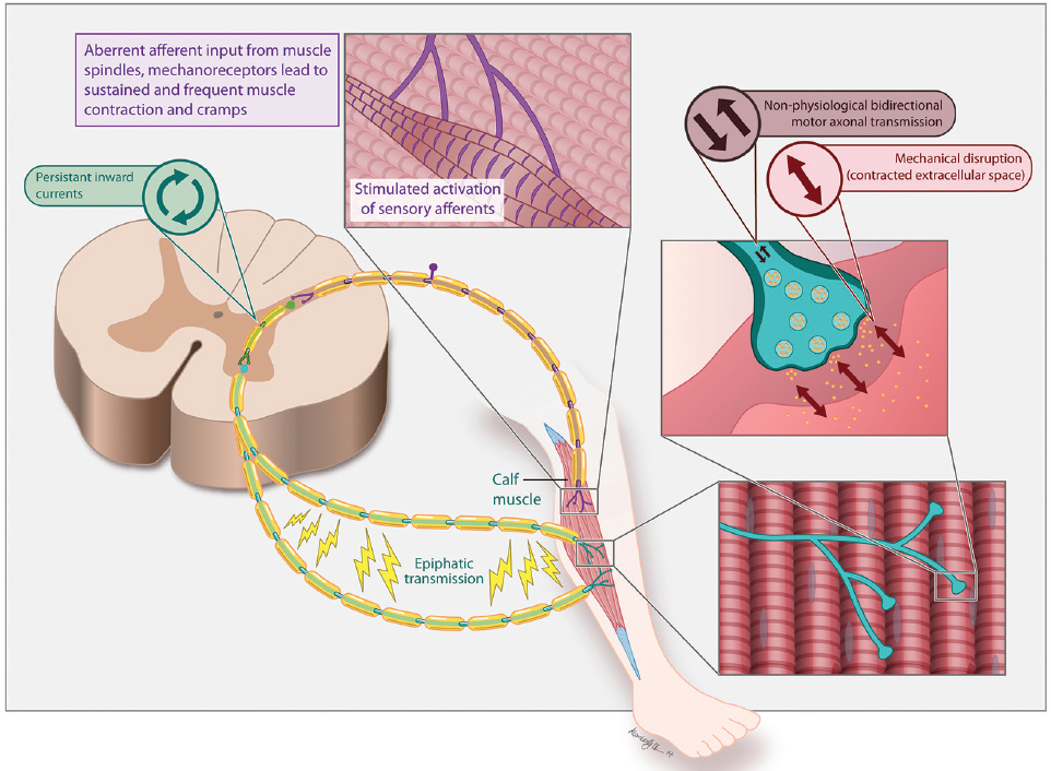 Figure 1: Pathophysiology Underlying Neurogenic Muscle Cramps.