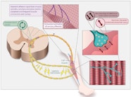 Muscle Cramps Practical Neurology 2022 