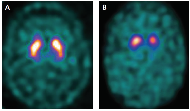 Ventilación Gimnasio víctima Imaging in Parkinson's Disease - Practical Neurology