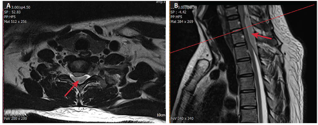 Figure 1. Axial (A) and sagittal (B) T2-weighted MRI shows a large compressive epidural hematoma (arrow) extending from C5 to T2. The spinal cord is notably displaced ventrally and severely flattened.