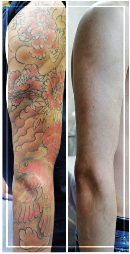 Picosecond Lasers: Meeting Advanced Tattoo Removal and Changing  Demographics Needs - Modern Aesthetics