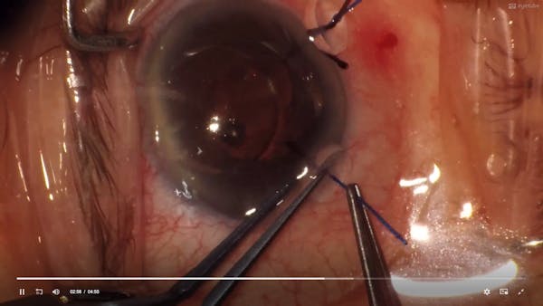 30g Needle Levitation of a Dropped IOL thumbnail