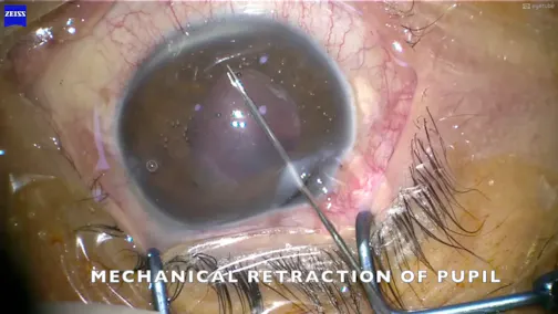 IOL Exchange in Buphthalmos, Retropupillary Artisan Iris Claw, and Pupiloplasty