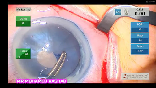 The Magic Tool for White Intumescent Cataract