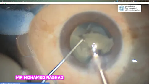 White Cataract With a Surprise