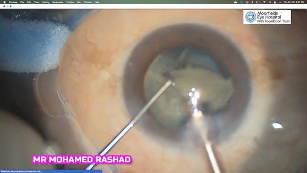 White Cataract With a Surprise thumbnail