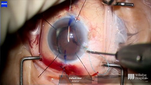 Pseudophakodonesis and UGH Syndrome