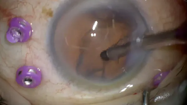 Thrombocytopenia thumbnail