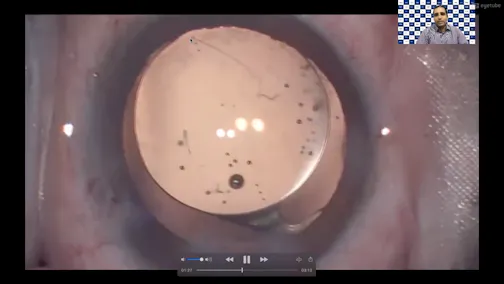 Reverse Capture With Toric IOL