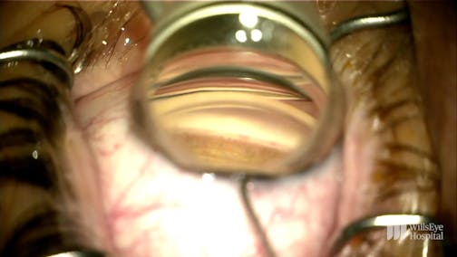 Combining Cataract and Glaucoma Surgery