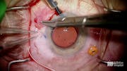 Exchanging a Dislocated Multifocal IOL