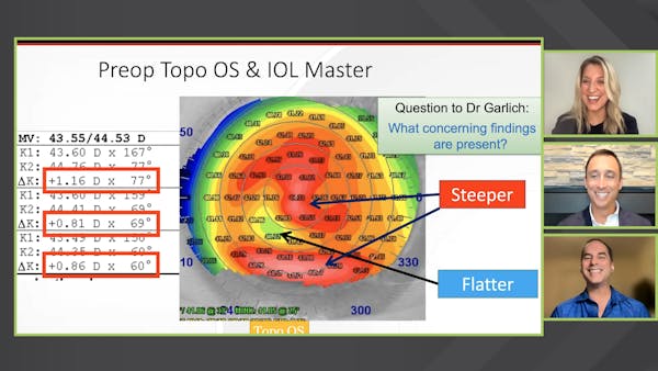 Impacts of Dry Eye and MGD on Cataract Surgery Planning thumbnail