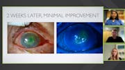 Red Eye to Epithelial Defect