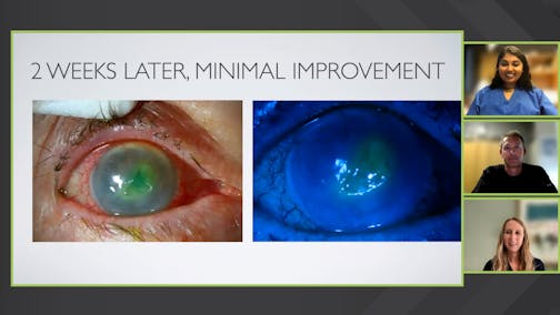 Red Eye to Epithelial Defect