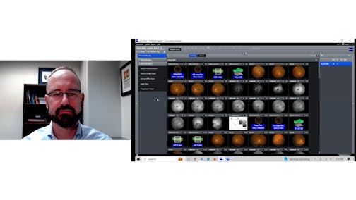 Using multi-modality in ZEISS Retina Workplace: A case of Neovascular AMD
