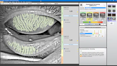 Oculus Launches AI-Assisted Tool to Improve Meibomian Gland Dysfunction Diagnostics image