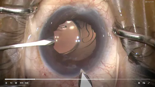 IOL Exchange With a Small Incision Scleral-Fixated IOL