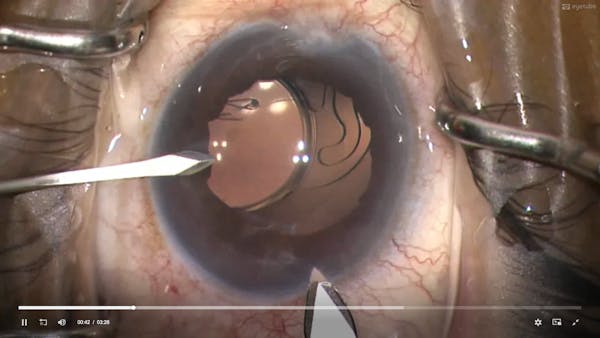 IOL Exchange With a Small Incision Scleral-Fixated IOL thumbnail