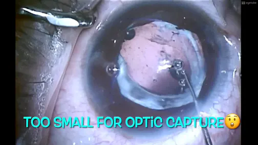 A Sulcus-Placed Single-Piece PCIOL Exchanged With a Three-Piece IOL With Optic Capture
