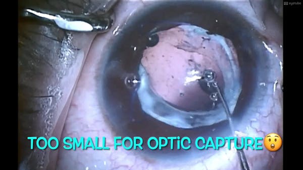 A Sulcus-Placed Single-Piece PCIOL Exchanged With a Three-Piece IOL With Optic Capture thumbnail
