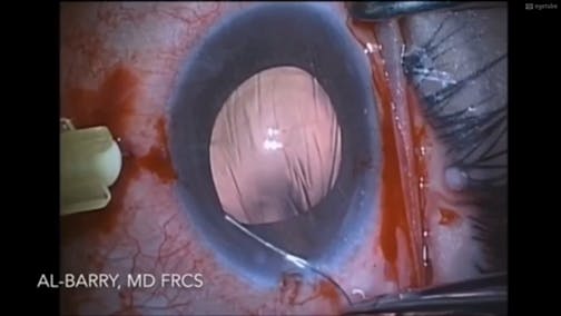 Transscleral Fixation Using a Combination of Six Techniques