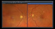 From Drusen to Atrophy: An AMD Journey Unveiled using ZEISS Retina Workflow