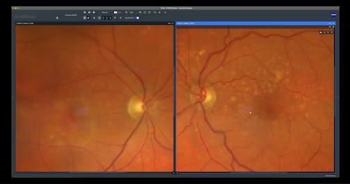 From Drusen to Atrophy: An AMD Journey Unveiled using ZEISS Retina Workflow