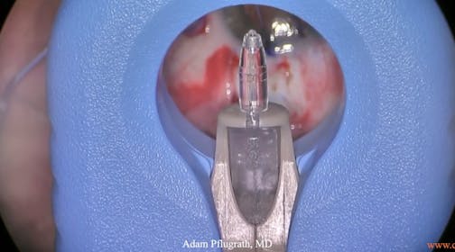 Susivimo: The Port Delivery System & Preparing the Implant