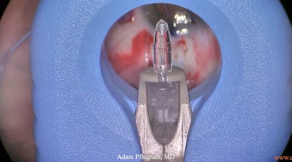 Susivimo: The Port Delivery System & Preparing the Implant thumbnail